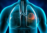 Ho kéo dài coi chừng ung thư phổi